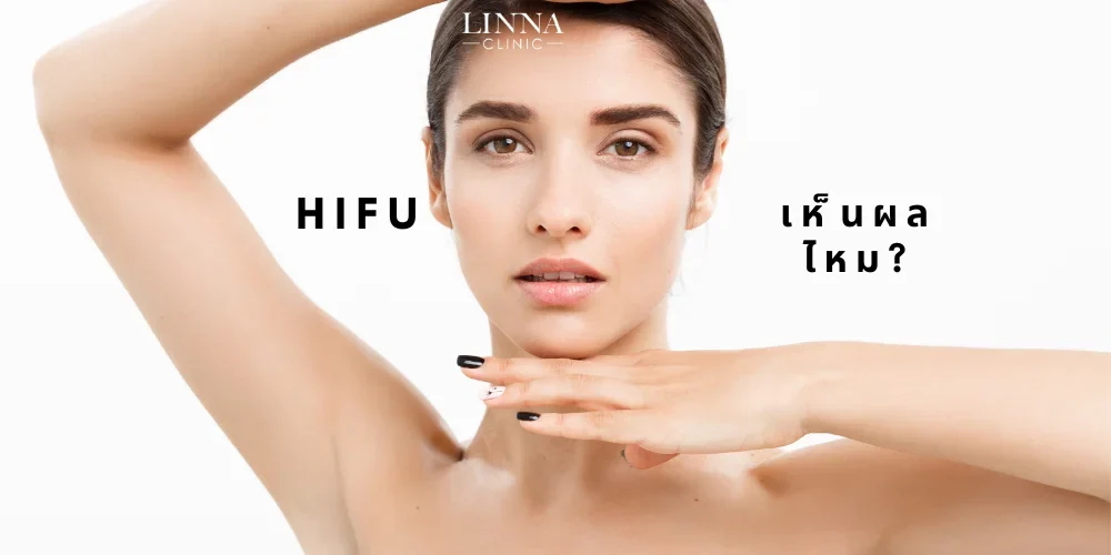 HIFU เห็นผลไหม?
