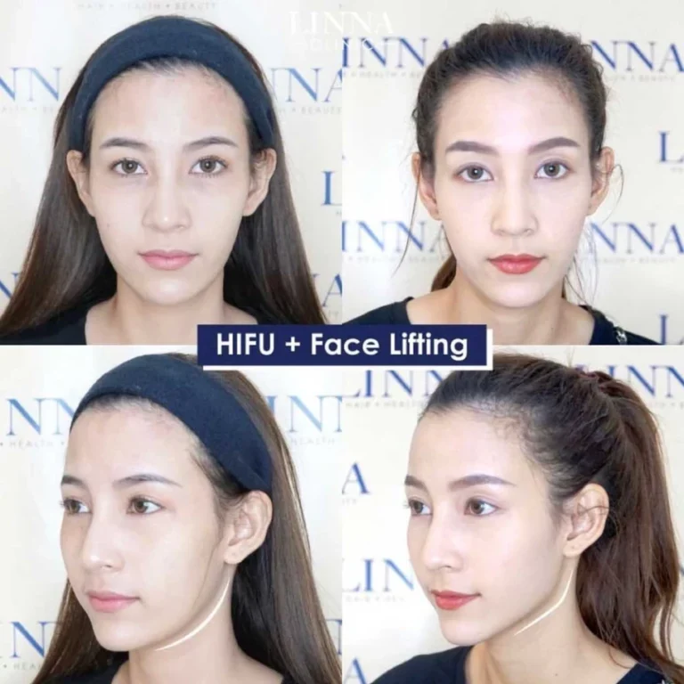 Hifu คืออะไร ยกกระชับจริงไหม รวมข้อเท็จจริงที่ต้องรู้