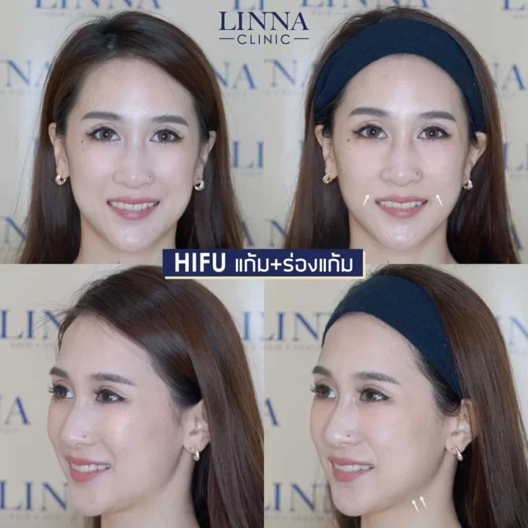 Hifu คืออะไร ยกกระชับจริงไหม รวมข้อเท็จจริงที่ต้องรู้