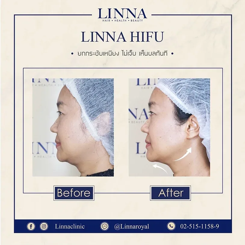 Hifu review