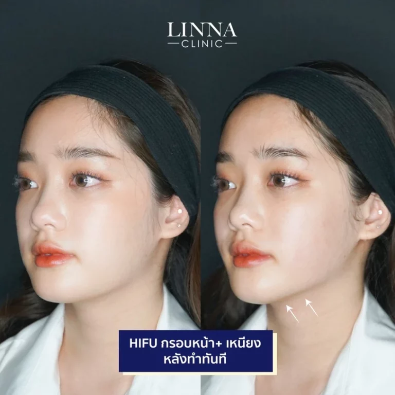 HIFU และ RF ยกกระชับหน้า ต่างกันอย่างไร เลือกทำแบบไหนดี