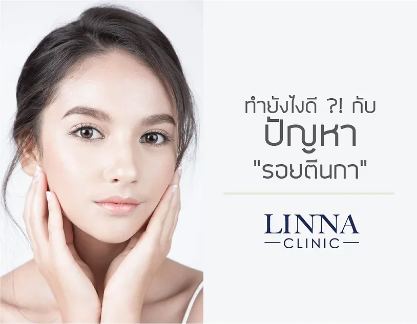ทำยังไงดี! กับปัญหารอยตีนกาที่มาเยือนบนใบหน้า