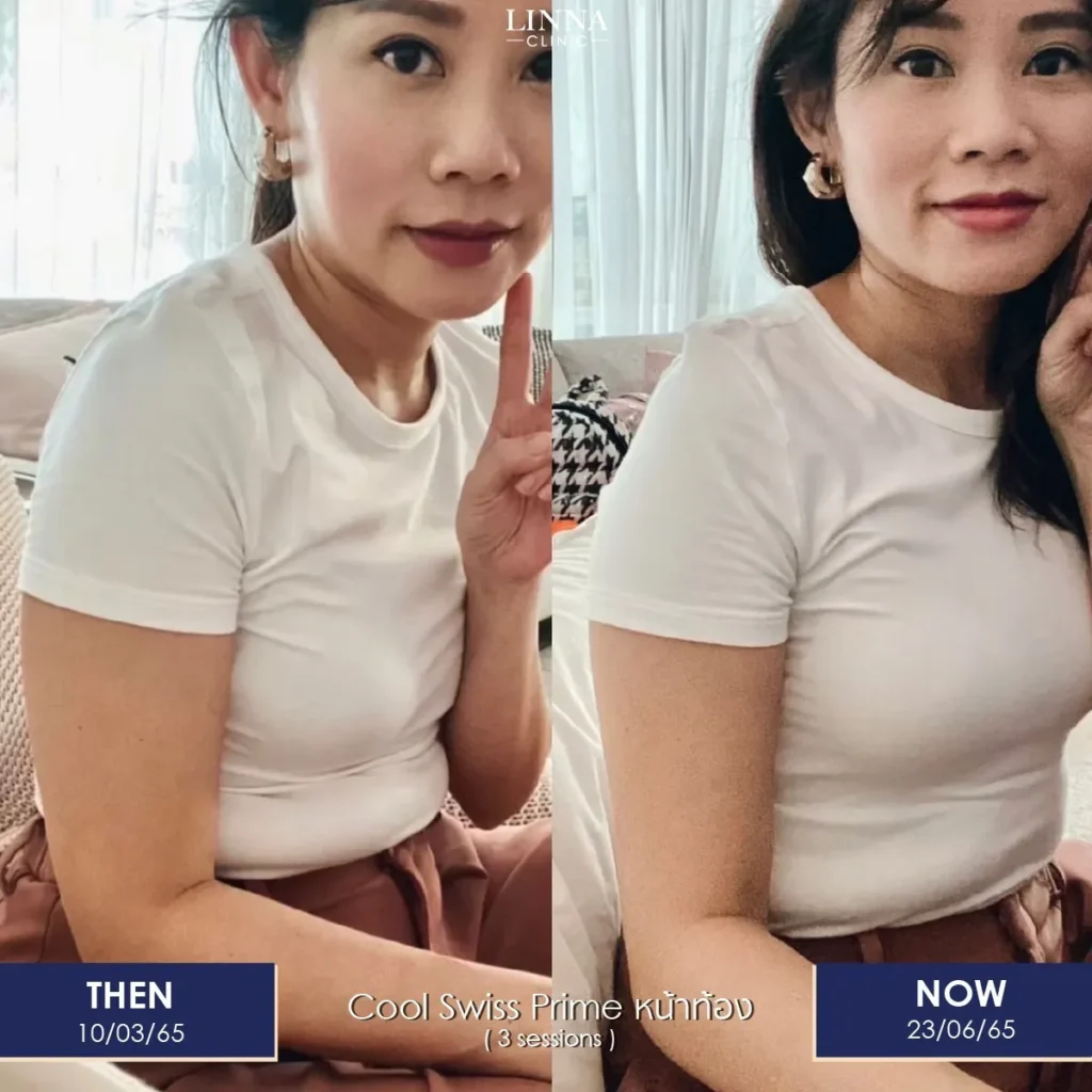 Reduce Inches and Sculpt Your Body Without Surgery with LINNA Body Sculpting by iCOONE® + CoolSwissPrime Plus