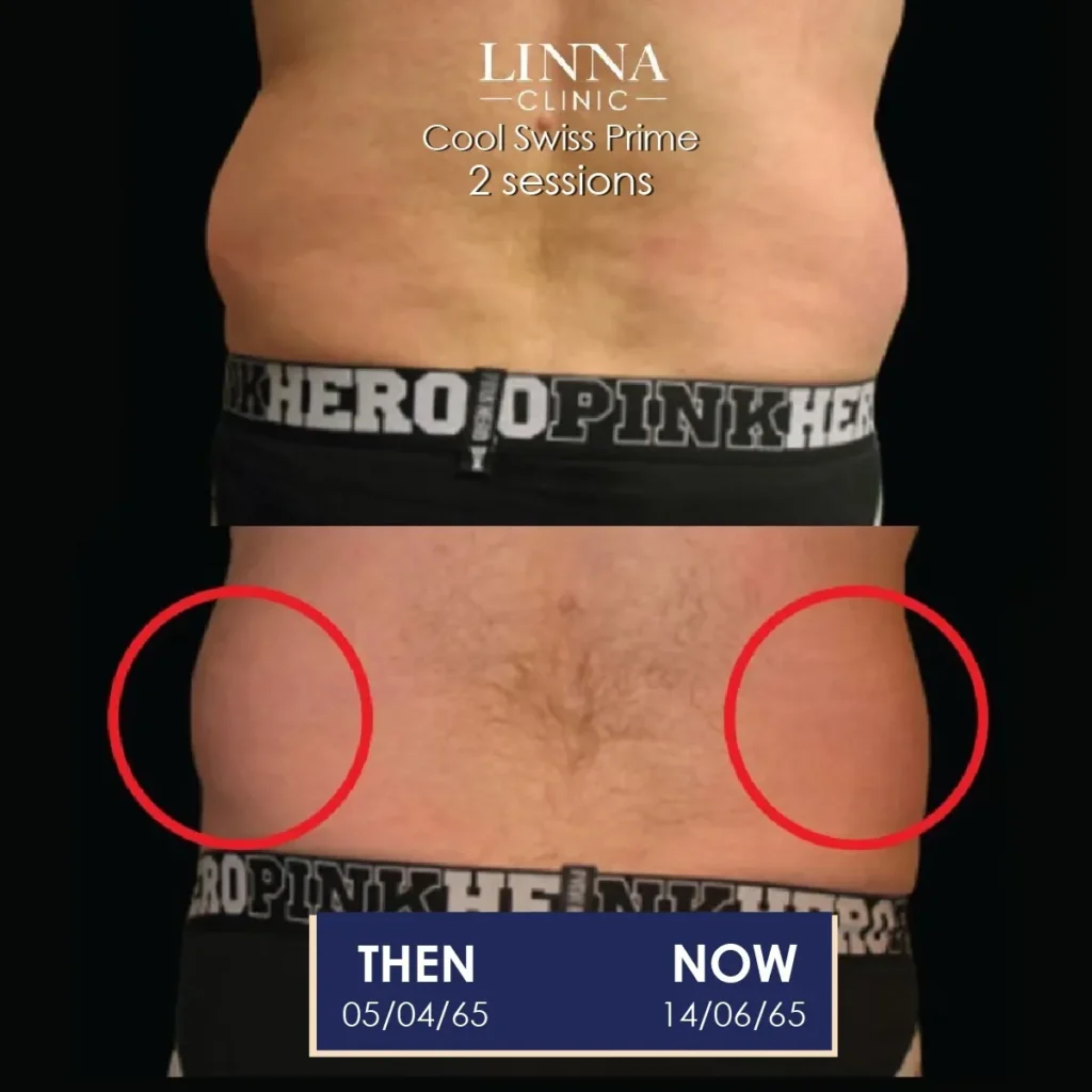 Reduce Inches and Sculpt Your Body Without Surgery with LINNA Body Sculpting by iCOONE® + CoolSwissPrime Plus