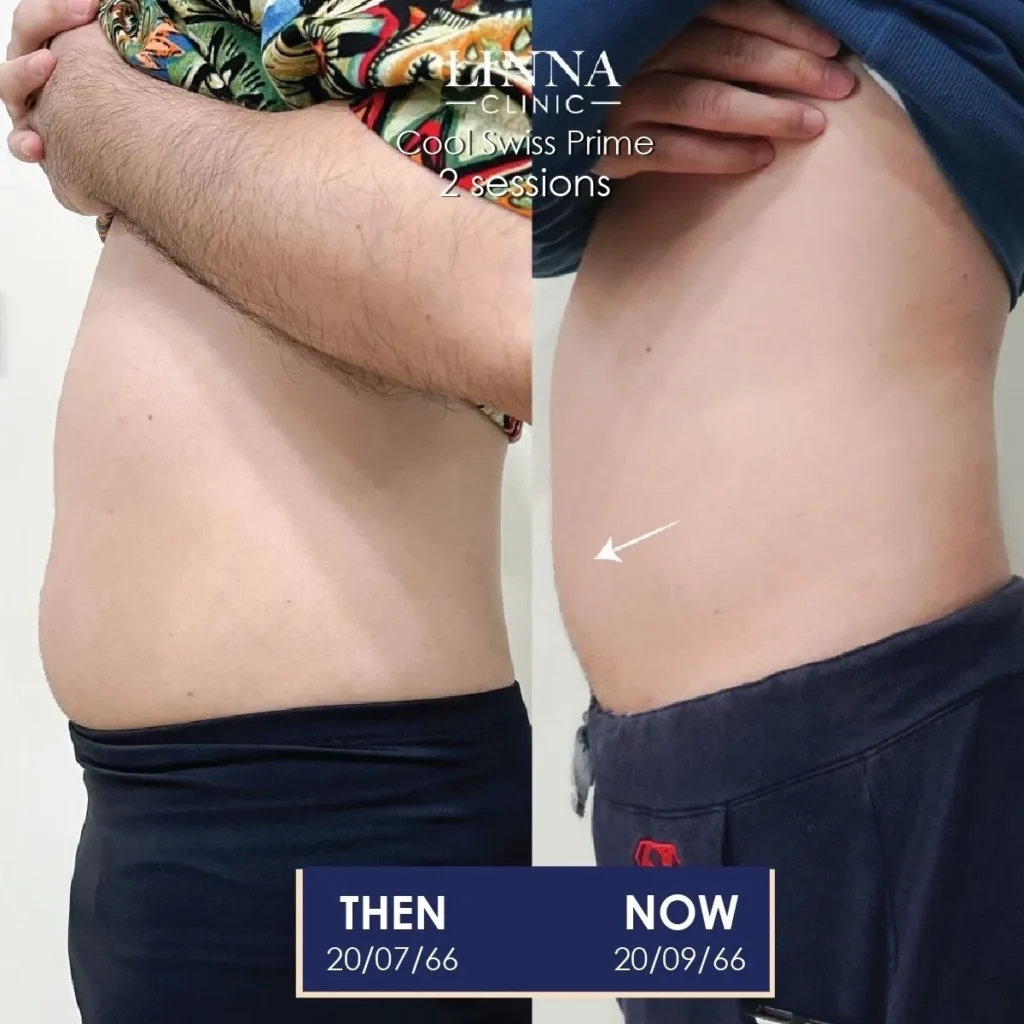 Reduce Inches and Sculpt Your Body Without Surgery with LINNA Body Sculpting by iCOONE® + CoolSwissPrime Plus