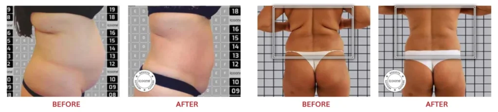 Reduce Inches and Sculpt Your Body Without Surgery with LINNA Body Sculpting by iCOONE® + CoolSwissPrime Plus