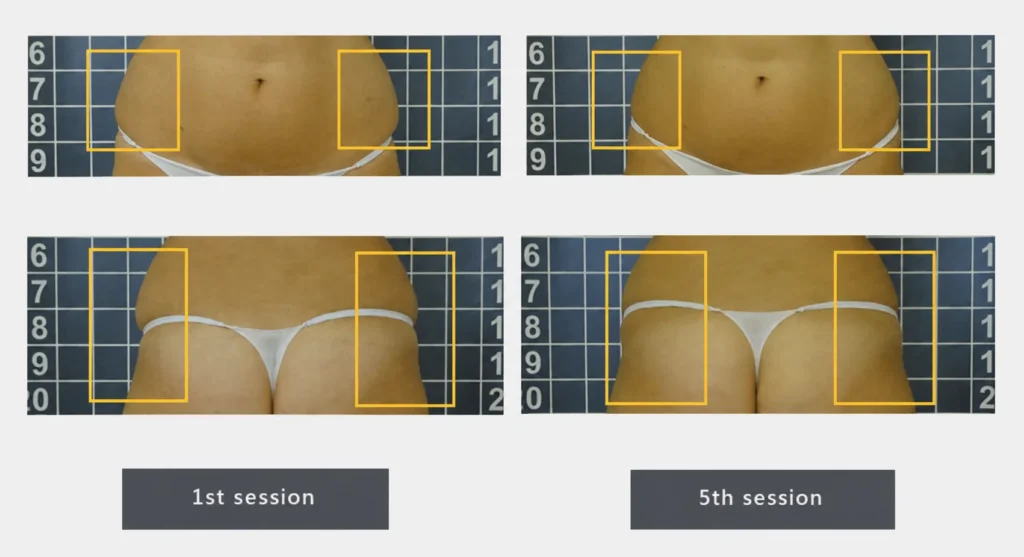 LINNA Body Sculpting by iCOONE® at LINNA Clinic