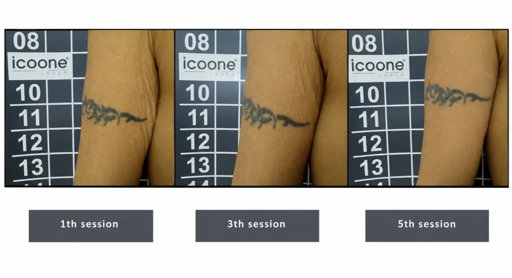 LINNA Body Sculpting by iCOONE® at LINNA Clinic