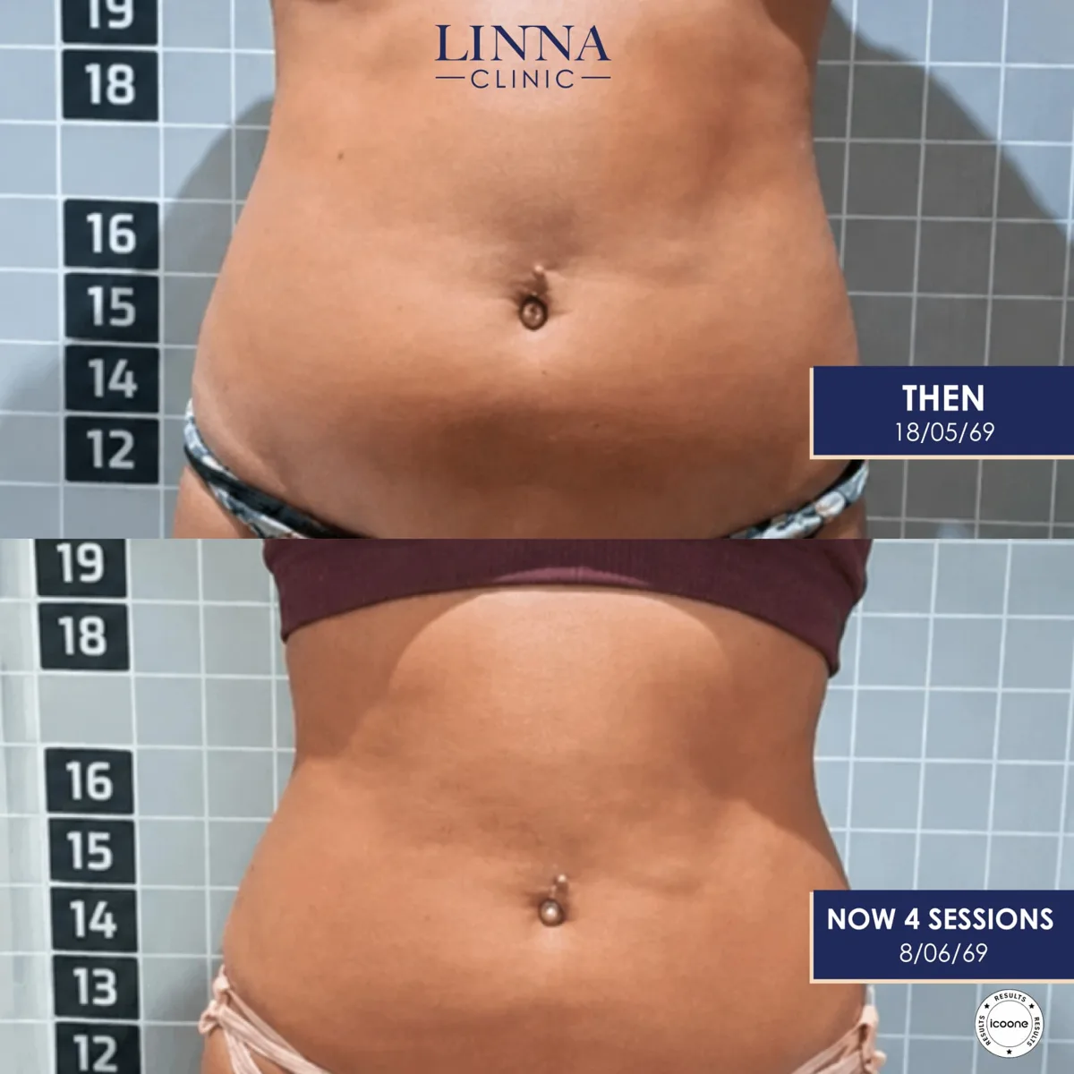 LINNA Body Sculpting by iCOONE® at LINNA Clinic