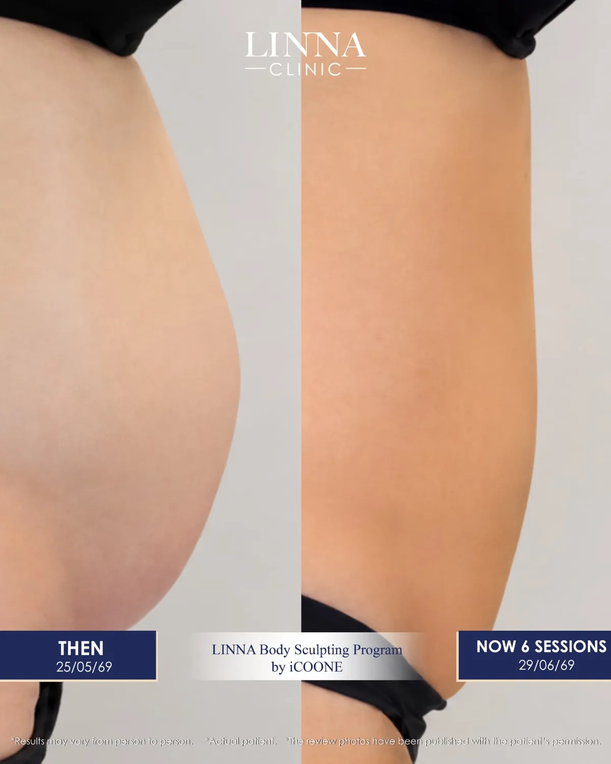 LINNA Body Sculpting by iCOONE® at LINNA Clinic