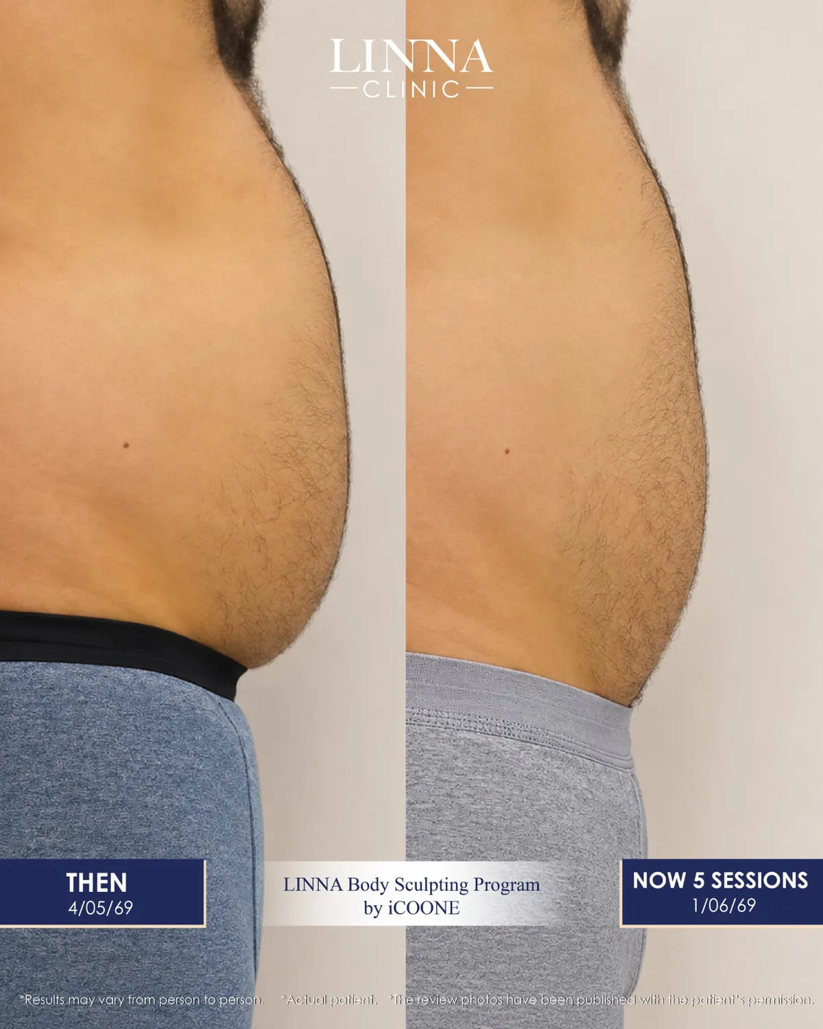 LINNA Body Sculpting by iCOONE® at LINNA Clinic