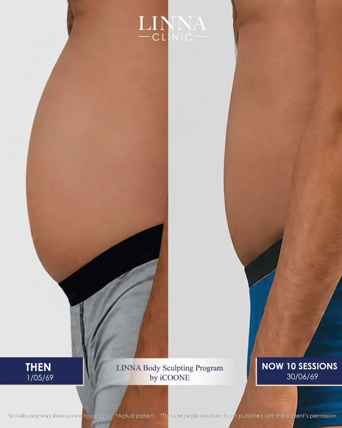 LINNA Body Sculpting by iCOONE® at LINNA Clinic