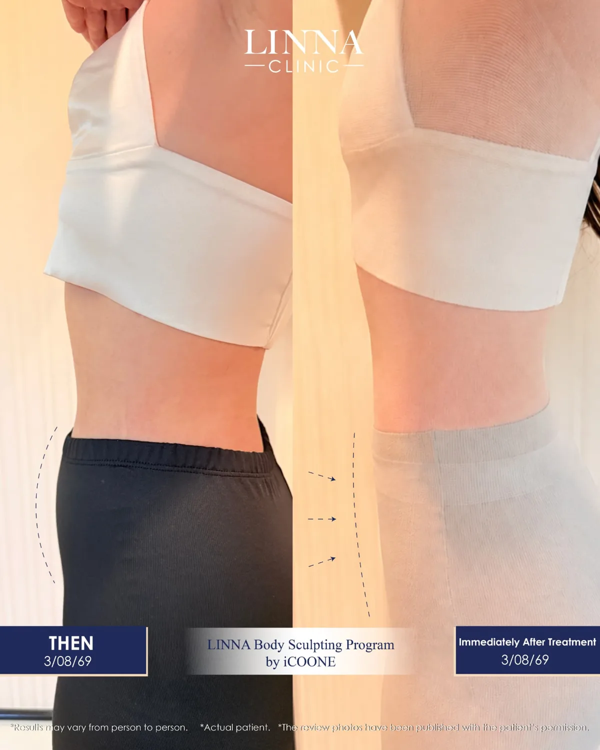 LINNA Body Sculpting by iCOONE® at LINNA Clinic