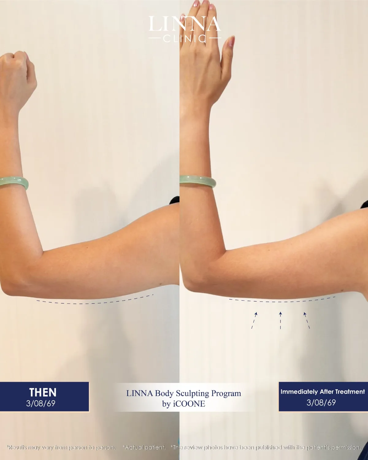 LINNA Body Sculpting by iCOONE® at LINNA Clinic