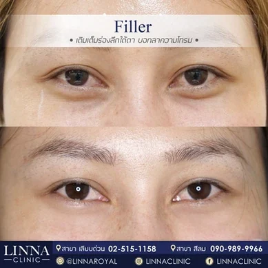 รีวิวฉีดฟิลเลอร์ใต้ตา Linna Clinic