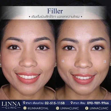 รีวิวฉีดฟิลเลอร์ใต้ตา Linna Clinic