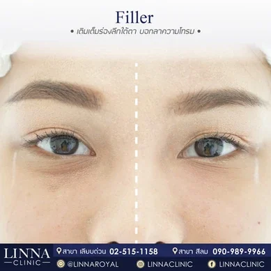 รีวิวฉีดฟิลเลอร์ใต้ตา Linna Clinic