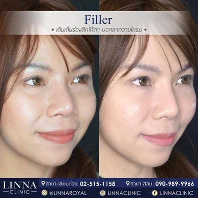 รีวิวฉีดฟิลเลอร์ใต้ตา Linna Clinic