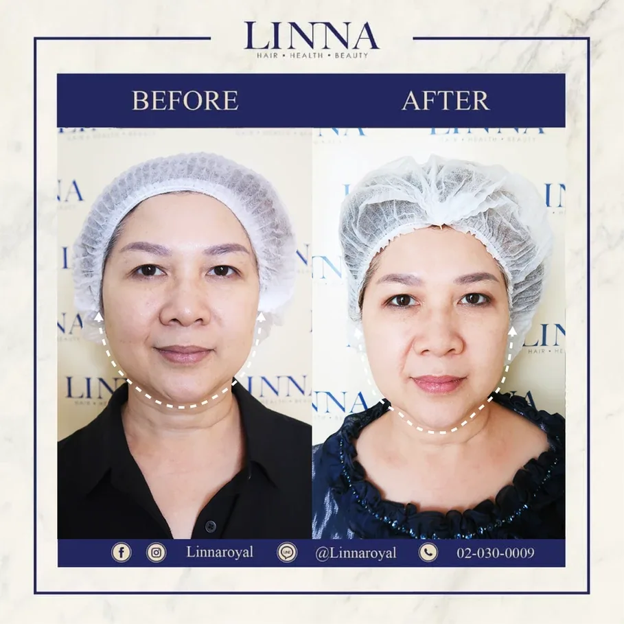 Thermage CPT คืออะไร
