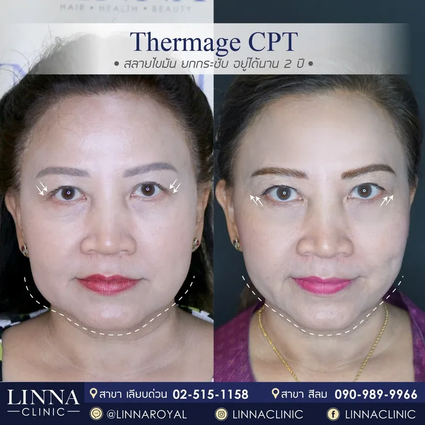 Thermage คืออะไร รวบรวมข้อควรรู้ก่อนทำ Thermage