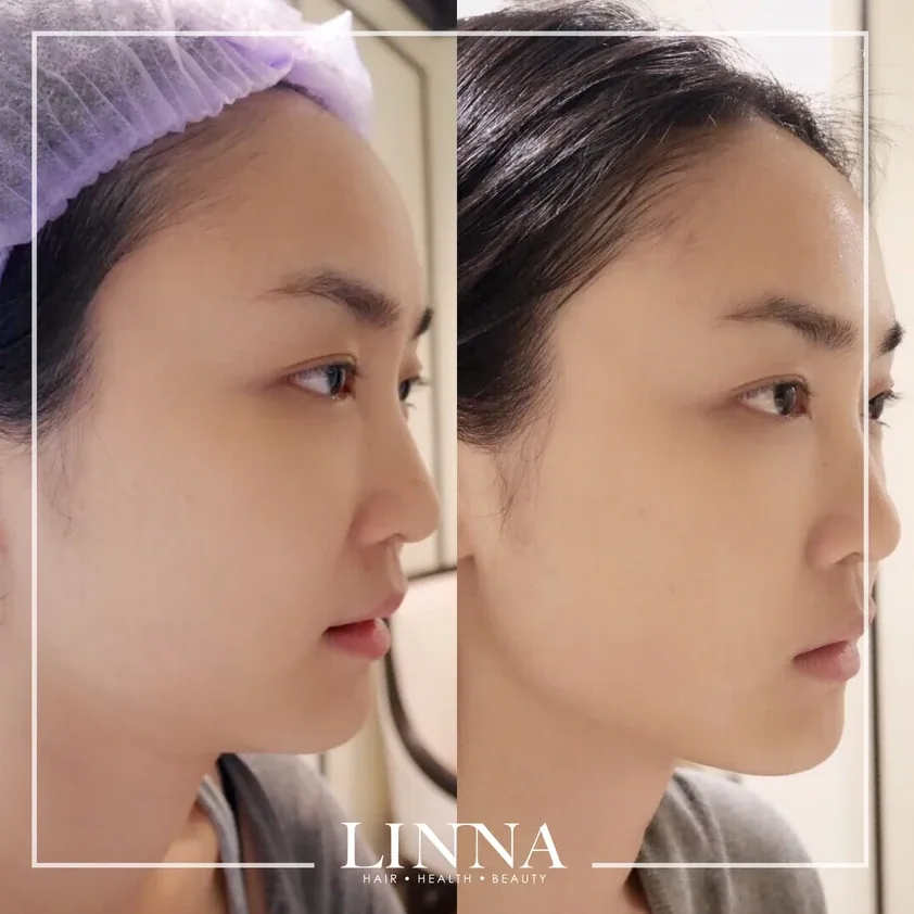 Thermage คืออะไร รวบรวมข้อควรรู้ก่อนทำ Thermage