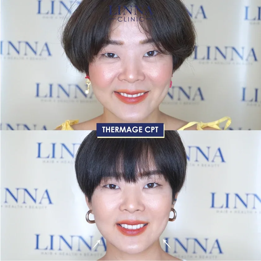 Thermage คืออะไร รวบรวมข้อควรรู้ก่อนทำ Thermage