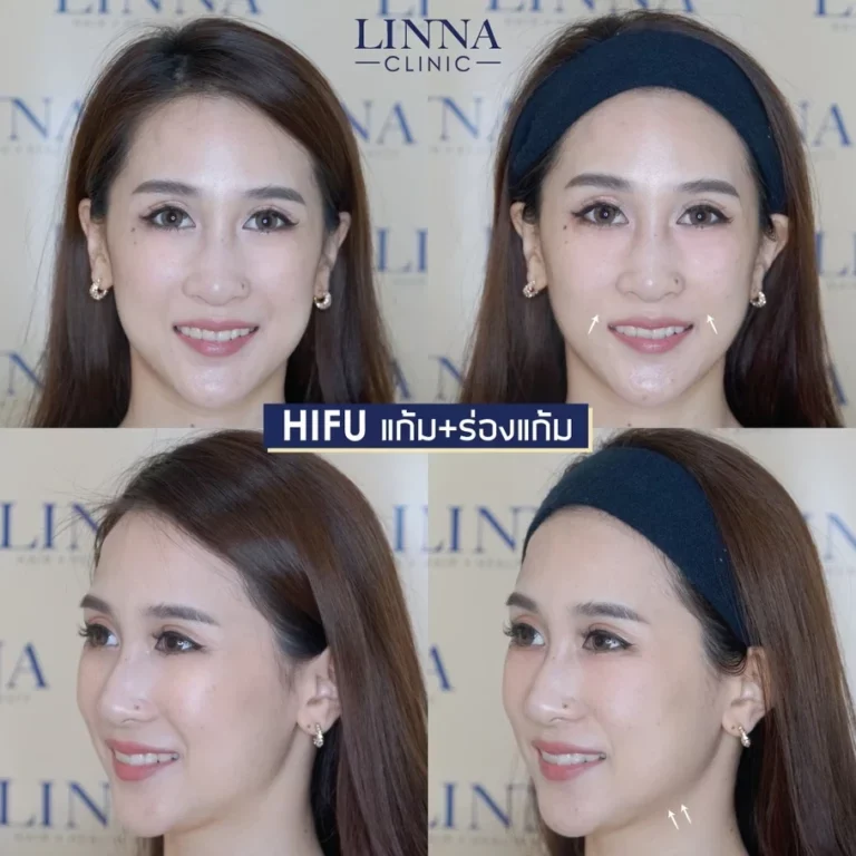 ทำไมทำ HIFU แล้วไม่เห็นผล มันเกิดจากอะไรกันแน่