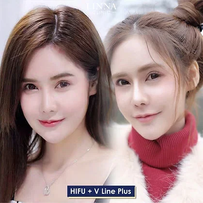 ทำไมทำ HIFU แล้วไม่เห็นผล มันเกิดจากอะไรกันแน่