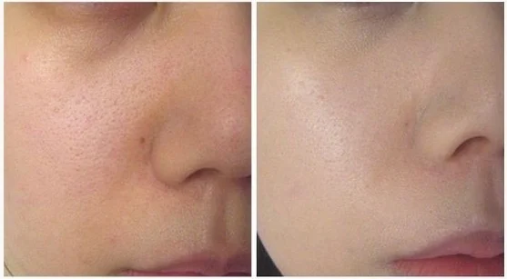 LINNA Dermafix at LINNA Clinic
