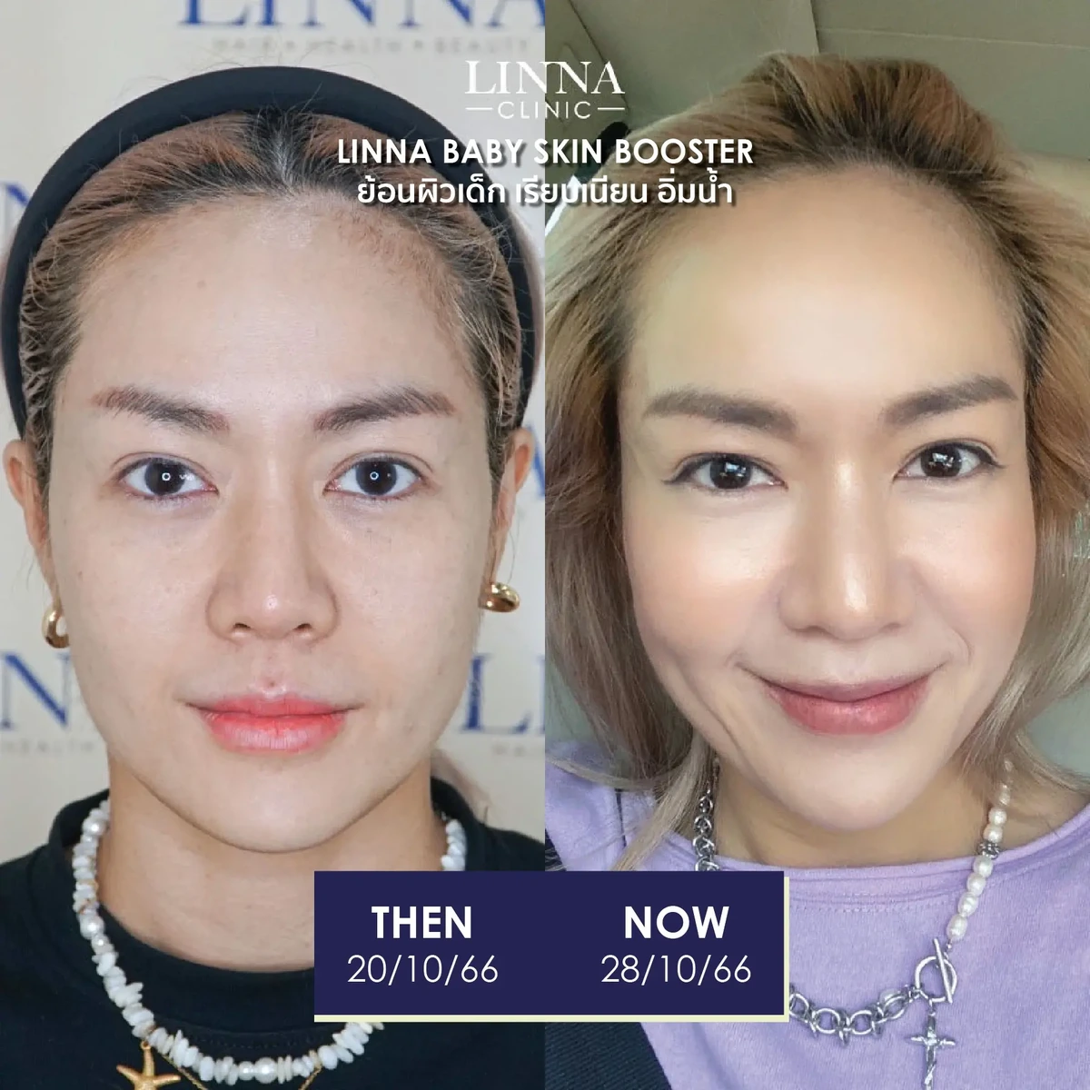 รีวิวก่อนและหลังทำ LINNA Baby Skin Booster