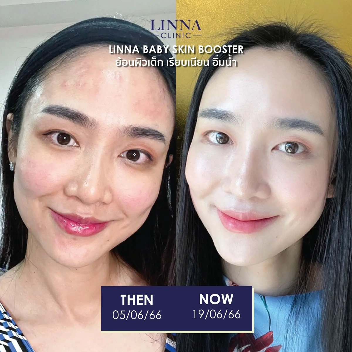 รีวิวก่อนและหลังทำ LINNA Baby Skin Booster