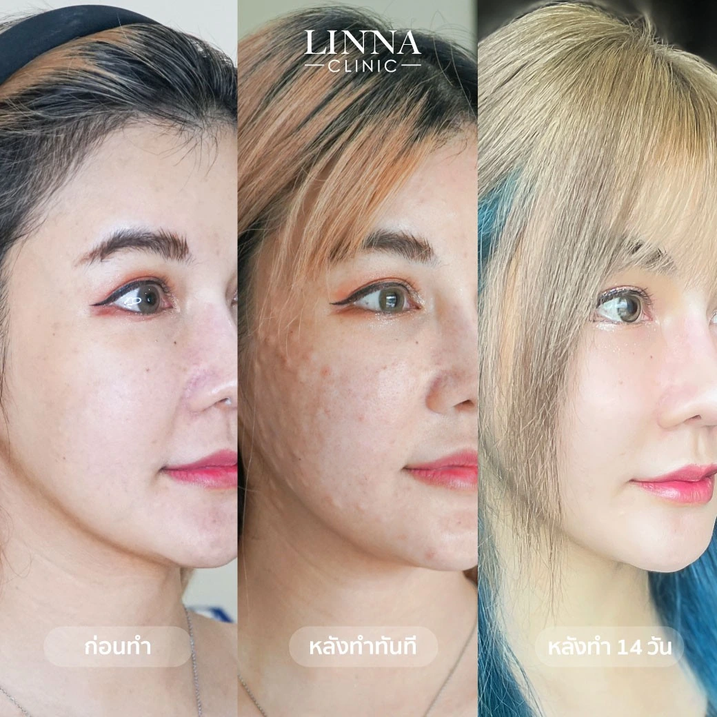รีวิวก่อนและหลังทำ LINNA Baby Skin Booster