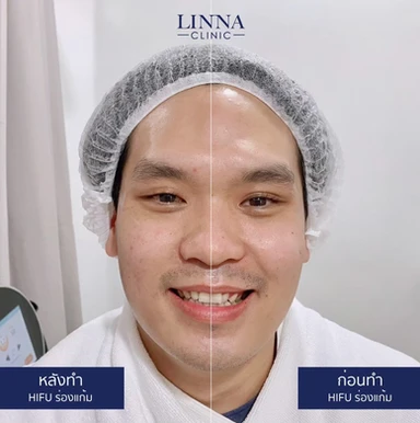 LINNA Clinic HIFU 8D คือนวัตกรรมการยกกระชับใบหน้าและร่างกายแบบไม่เจ็บจากเกาหลี