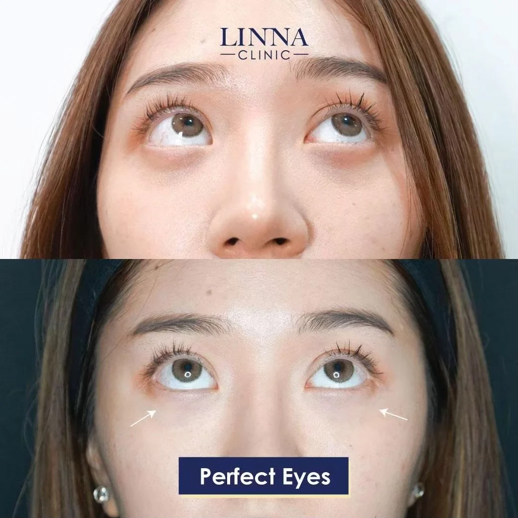 LINNA Perfect Eye before and after review 3