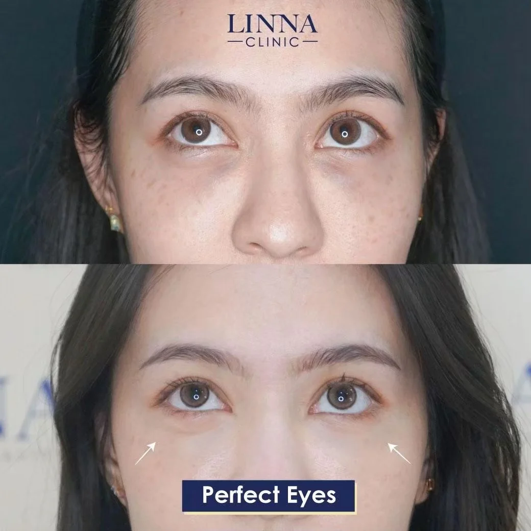LINNA Perfect Eye before and after review 5