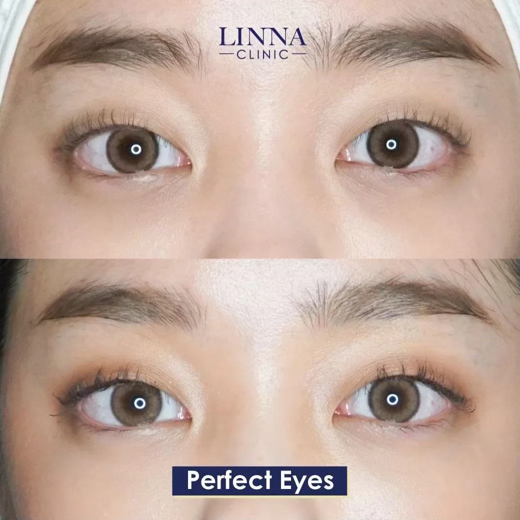 LINNA Perfect Eye before and after review 6