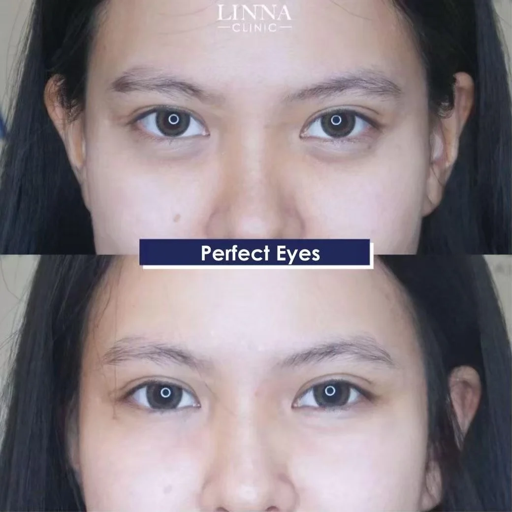 LINNA Perfect Eye before and after review 8