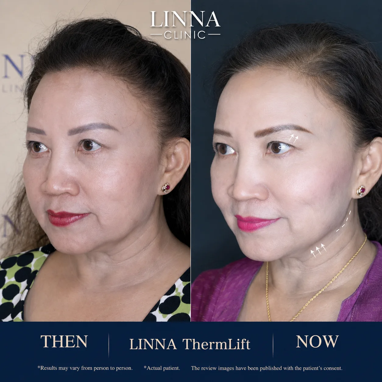 LINNA Thermage before and after - front view