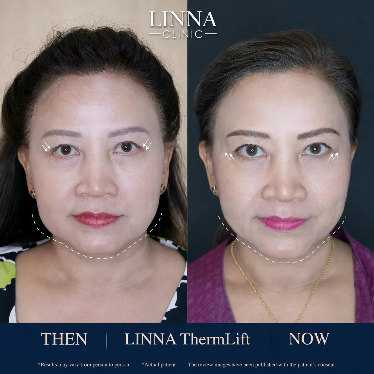 LINNA Thermage before and after - side view