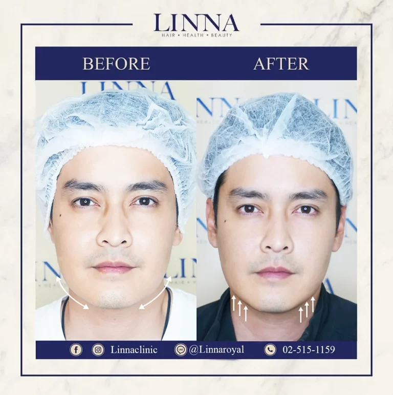 LINNA Clinic Botox โบท็อกซ์ ช่วยลดริ้วรอย ปรับรูปหน้าและรูปคิ้ว ไม่มีผลข้างเคียงและไม่ทิ้งสารตกค้างภายในร่างกาย