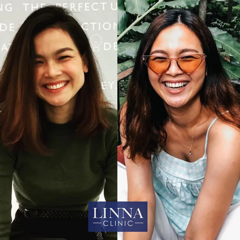 LINNA Clinic Botox โบท็อกซ์ ช่วยลดริ้วรอย ปรับรูปหน้าและรูปคิ้ว ไม่มีผลข้างเคียงและไม่ทิ้งสารตกค้างภายในร่างกาย