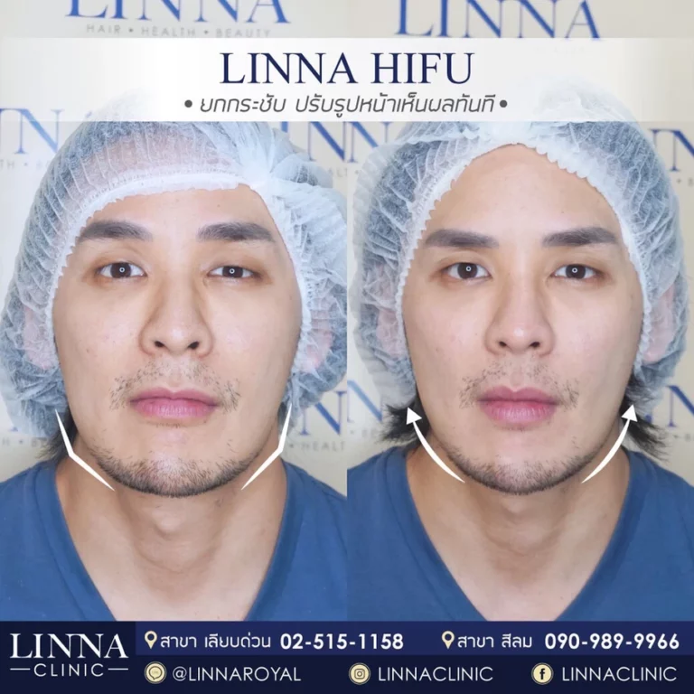 LINNA Clinic HIFU 8D คือนวัตกรรมการยกกระชับใบหน้าและร่างกายแบบไม่เจ็บจากเกาหลี