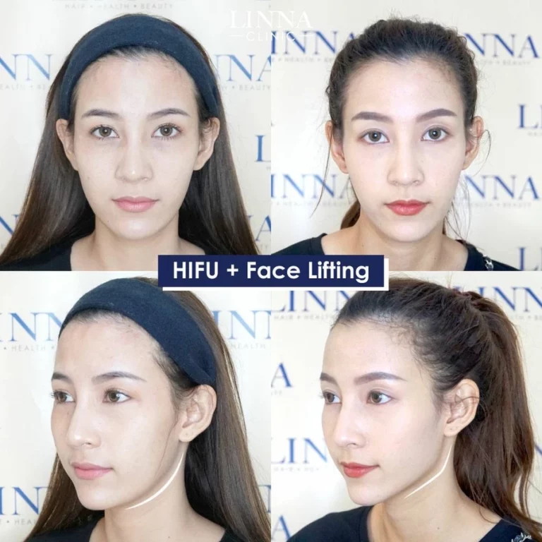 LINNA Clinic HIFU 8D คือนวัตกรรมการยกกระชับใบหน้าและร่างกายแบบไม่เจ็บจากเกาหลี