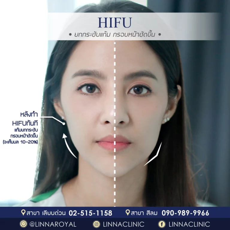 LINNA Clinic HIFU 8D คือนวัตกรรมการยกกระชับใบหน้าและร่างกายแบบไม่เจ็บจากเกาหลี