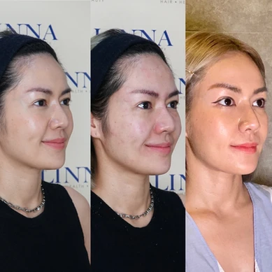 รีวิวฟิลเลอร์ยกกระชับที่ Linna Clinic