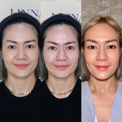 รีวิวฟิลเลอร์ยกกระชับที่ Linna Clinic