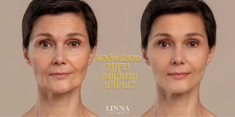 inna-ผลลัพธ์ของ-HIFU-อยู่ได้นานแค่ไหน