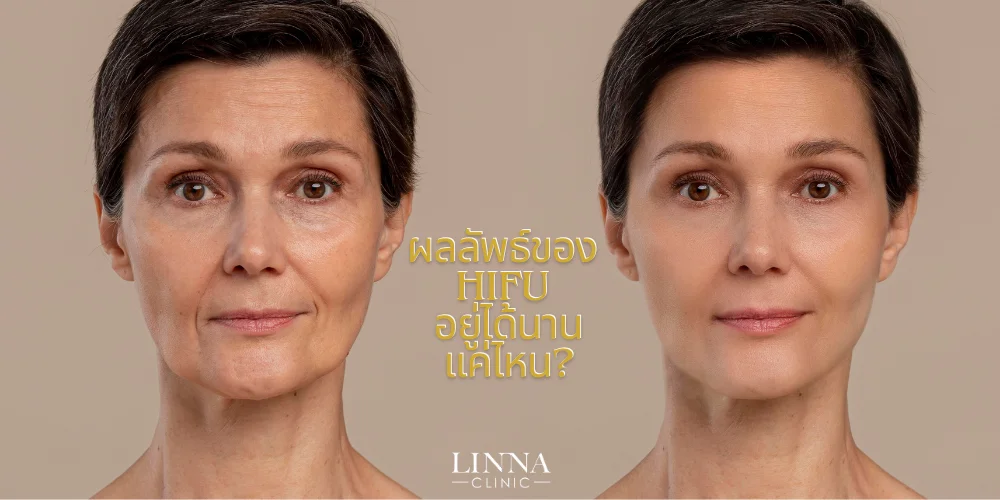 inna-ผลลัพธ์ของ-HIFU-อยู่ได้นานแค่ไหน