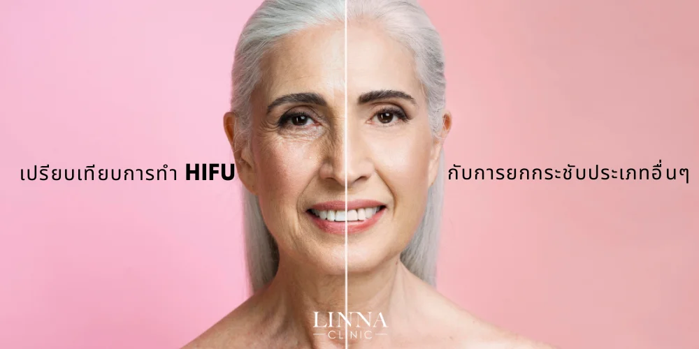 เปรียบเทียบการทำ-HIFU-กับการยกกระชับประเภทอื่นๆ
