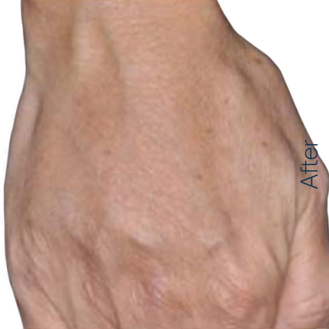 hand-after